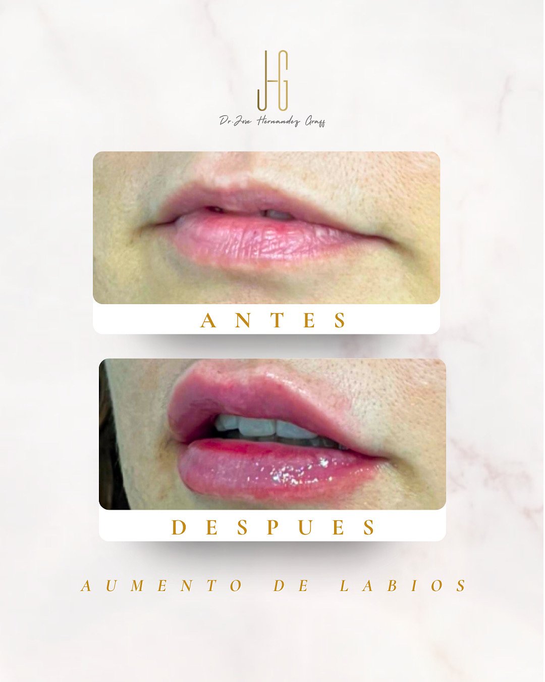 tratamiento antiarrugas - 23