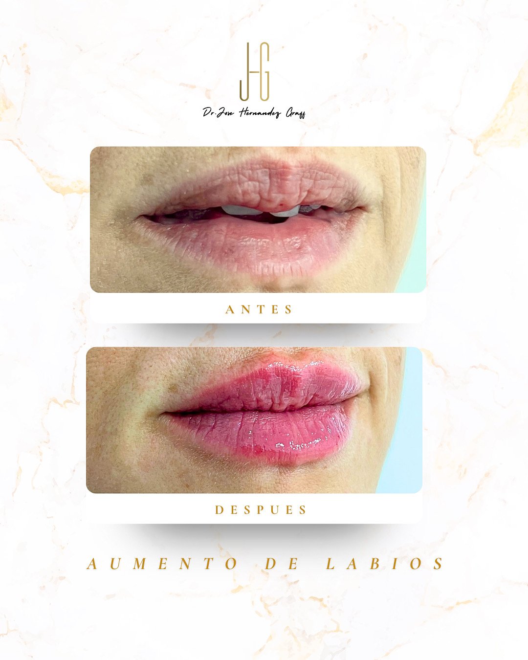 tratamiento antiarrugas - 7