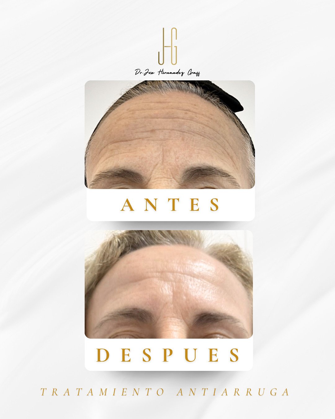 tratamiento antiarrugas - 14