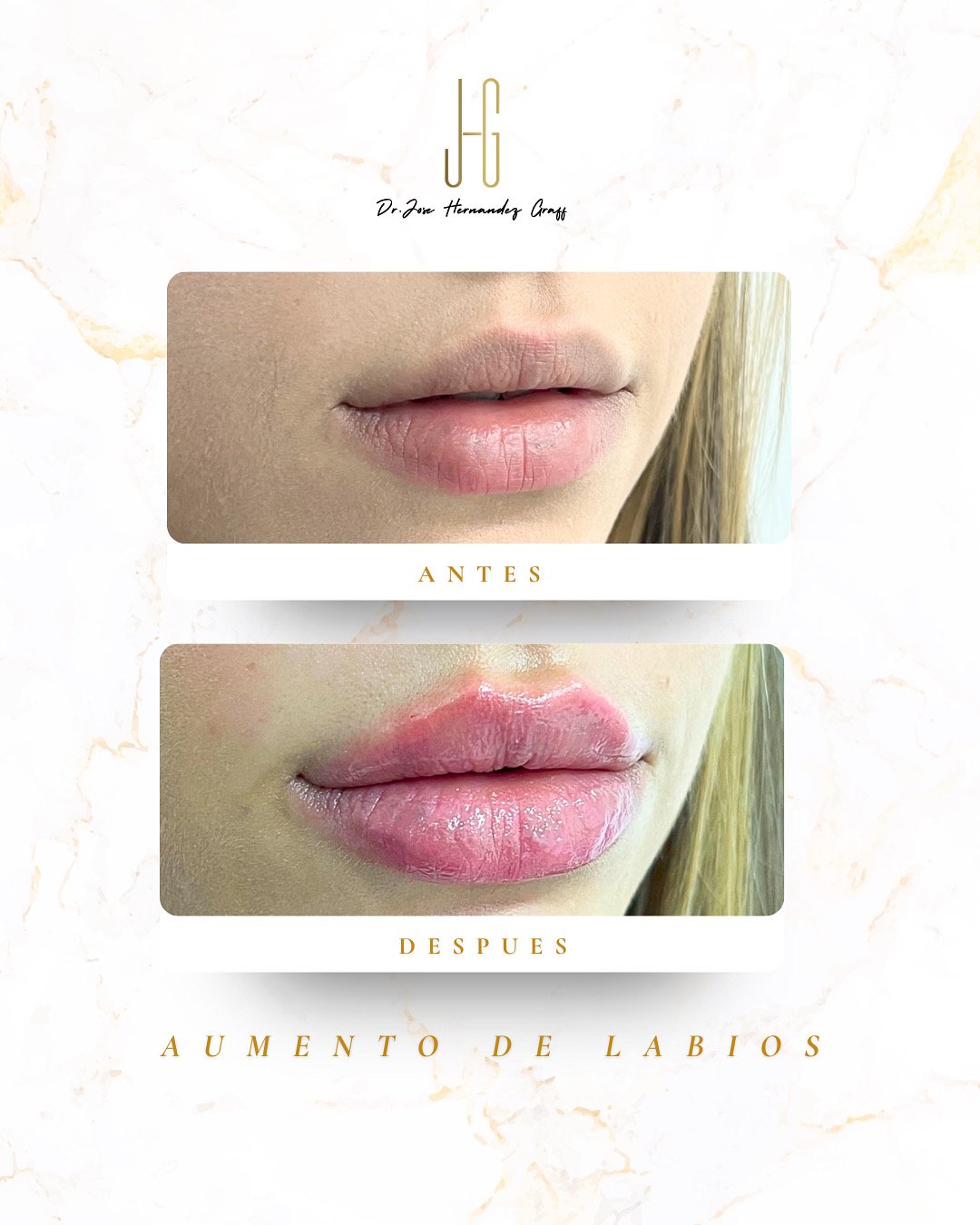 tratamiento antiarrugas - 10